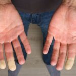 esclerodermia