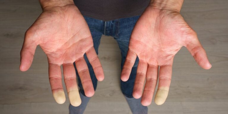 esclerodermia
