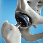 3d rendered medically accurate illustration of a hip replacement