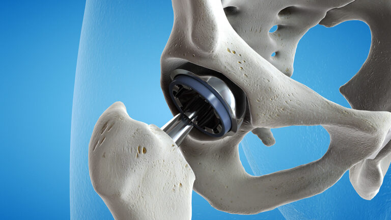 3d rendered medically accurate illustration of a hip replacement